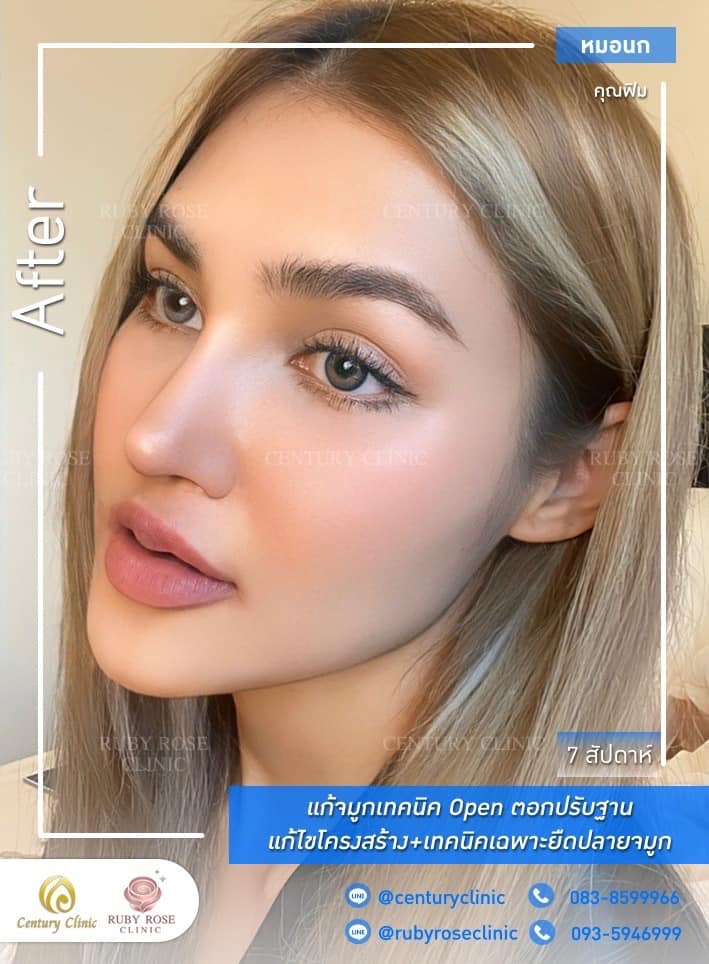 รีวิว แก้จมูก #451 , Century Clinic Thailand Century-รีวิว-แก้จมูก 1#451