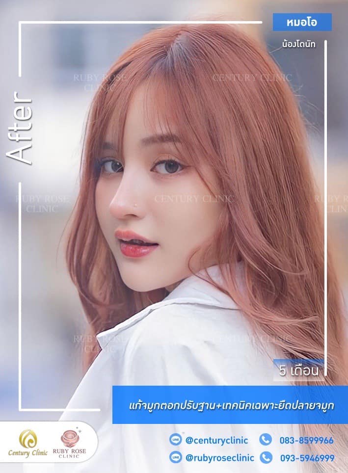 Century-รีวิว-แก้จมูก 1#452
