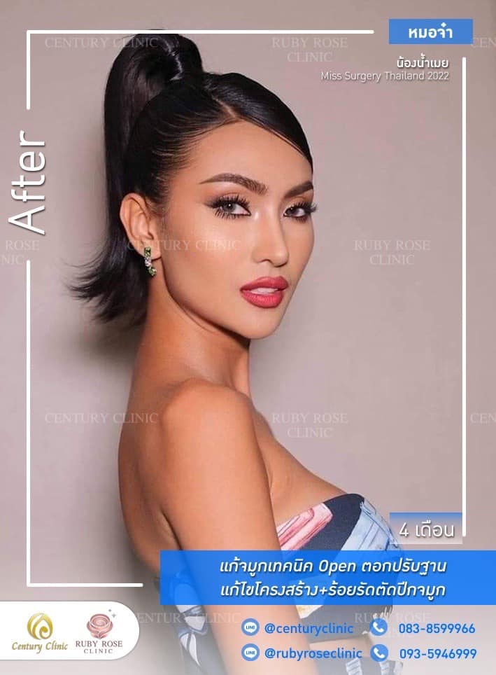 รีวิว แก้จมูก #455 , Century Clinic Thailand Century-รีวิว-แก้จมูก 1#455