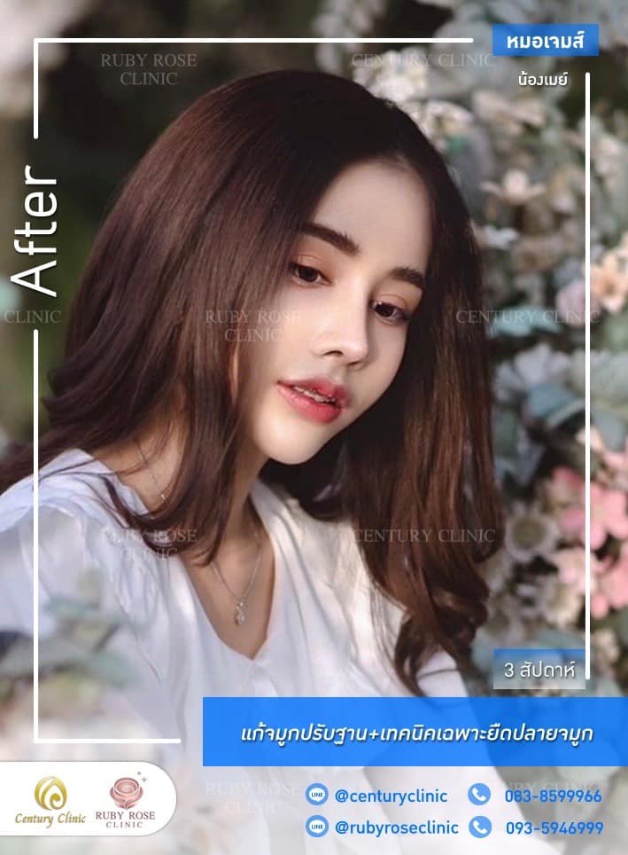 Century-รีวิว-แก้จมูก 1#461