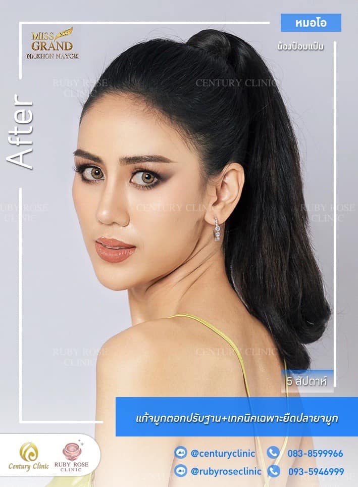 Century-รีวิว-แก้จมูก 1#463