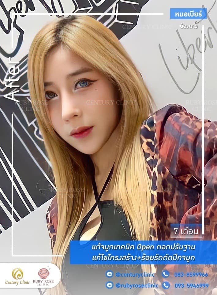 Century-รีวิว-แก้จมูก 1#464