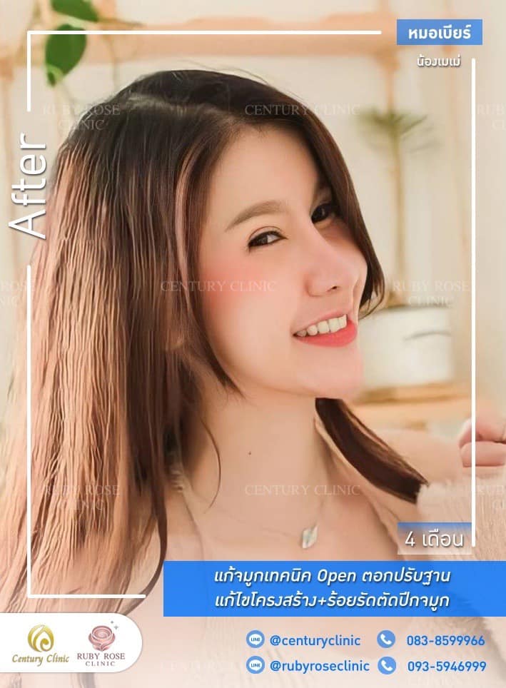 รีวิว แก้จมูก #469 , Century Clinic Thailand Century-รีวิว-แก้จมูก 1#469