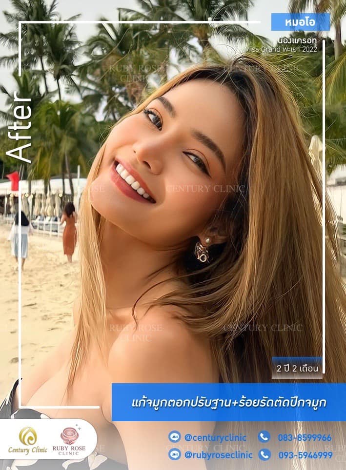 Century-รีวิว-แก้จมูก 1#472