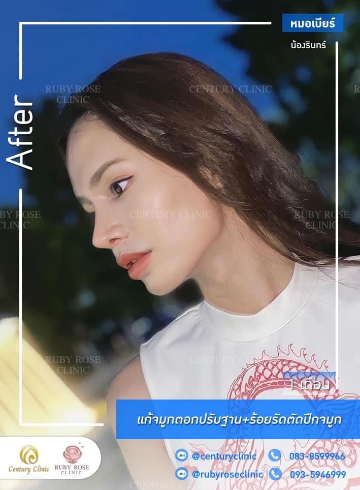 Century-รีวิว-แก้จมูก 1#473