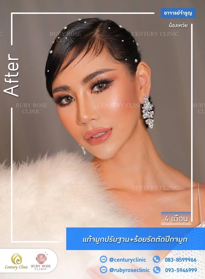 Century-รีวิว-แก้จมูก 1#474