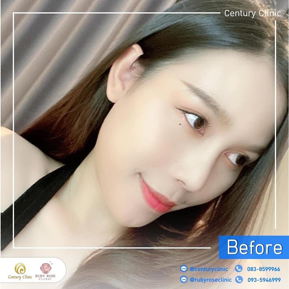 Century-รีวิว-แก้จมูก 1#475