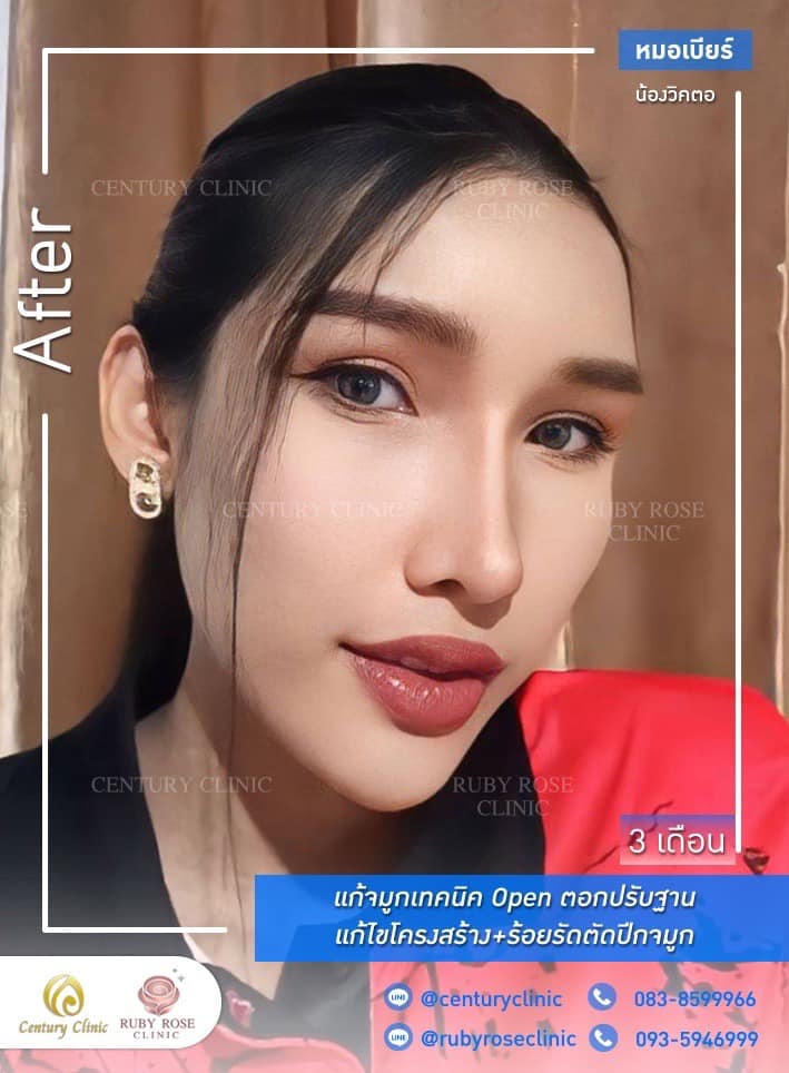 Century-รีวิว-แก้จมูก 1#478