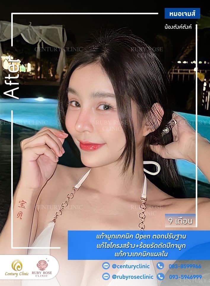 Century-รีวิว-แก้จมูก 1#480