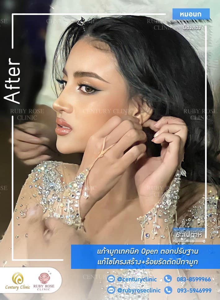 Century-รีวิว-แก้จมูก 1#481