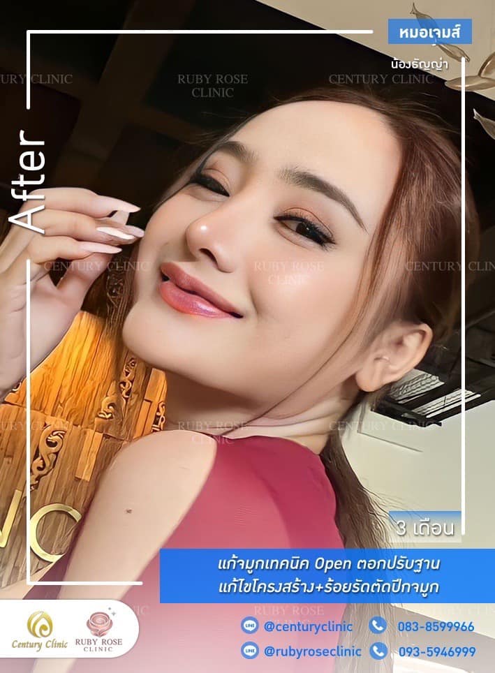 รีวิว แก้จมูก #485 , Century Clinic Thailand Century-รีวิว-แก้จมูก 1#485