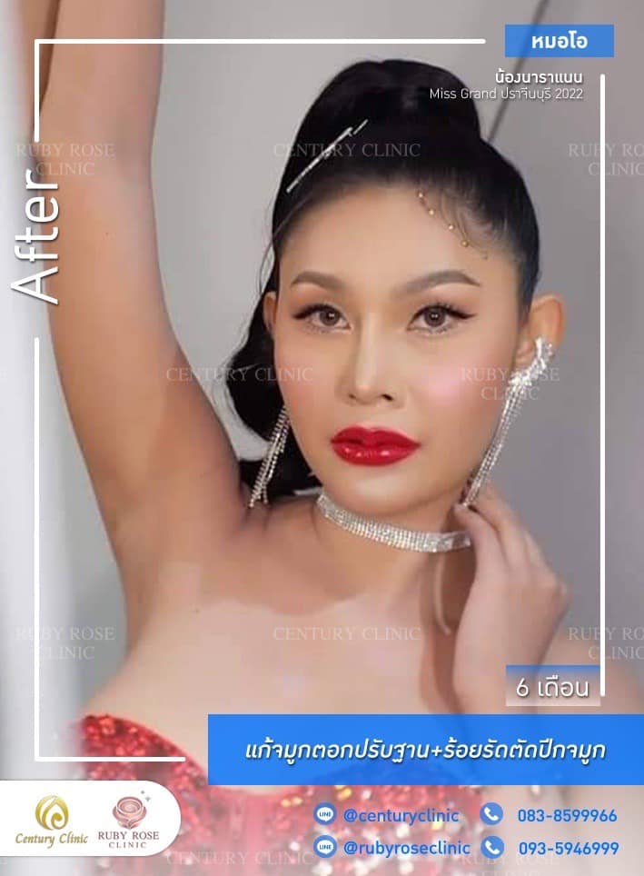 รีวิว แก้จมูก #487 , Century Clinic Thailand Century-รีวิว-แก้จมูก 1#487