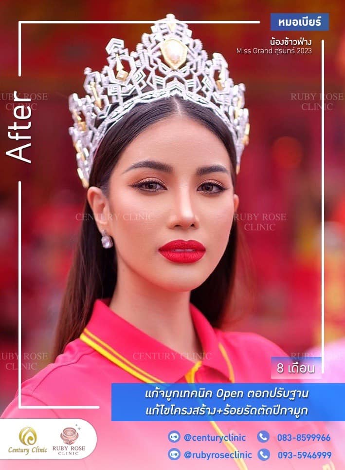 Century-รีวิว-แก้จมูก 1#488