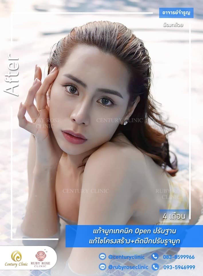 Century-รีวิว-แก้จมูก 1#490