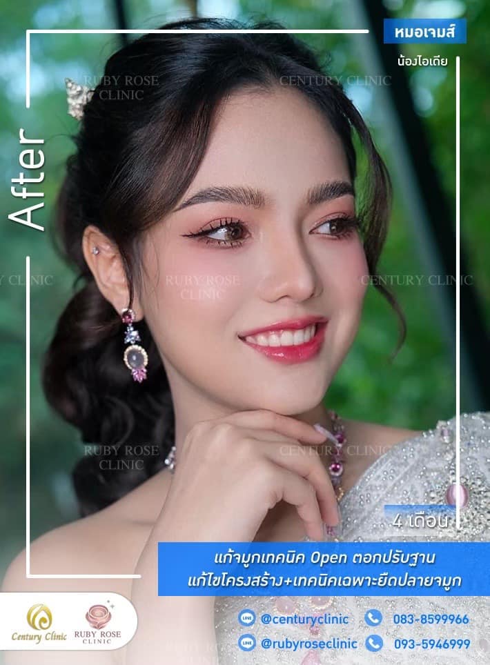 Century-รีวิว-แก้จมูก 1#491