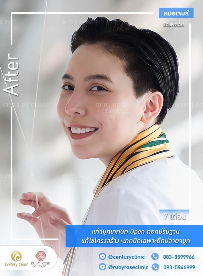 Century-รีวิว-แก้จมูก 1#494
