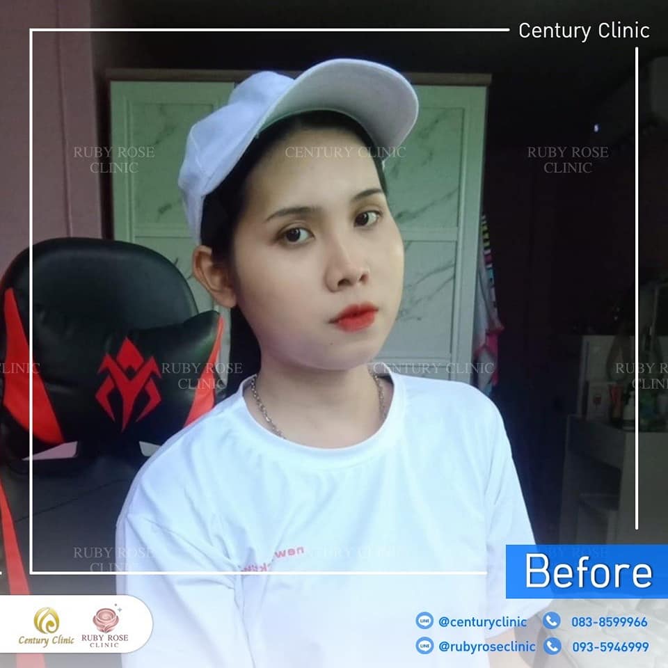 Century-รีวิว-แก้จมูก 1#499
