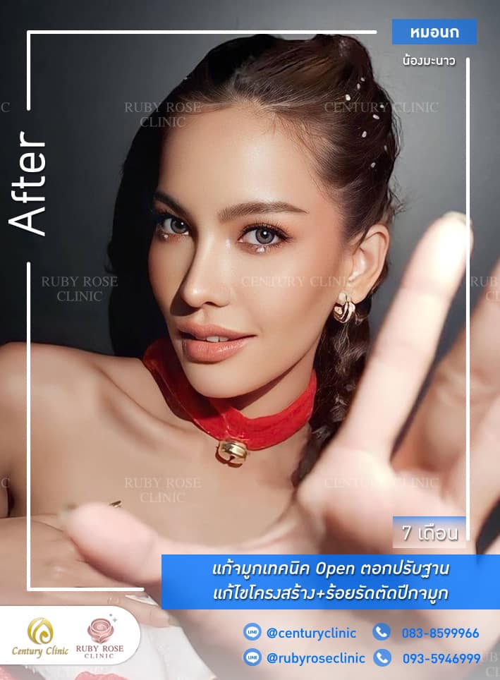 Century-รีวิว-แก้จมูก 1#500