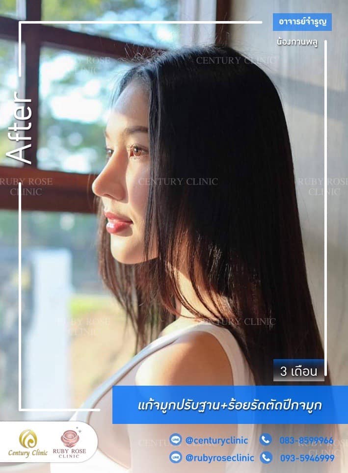 Century-รีวิว-แก้จมูก 1#503