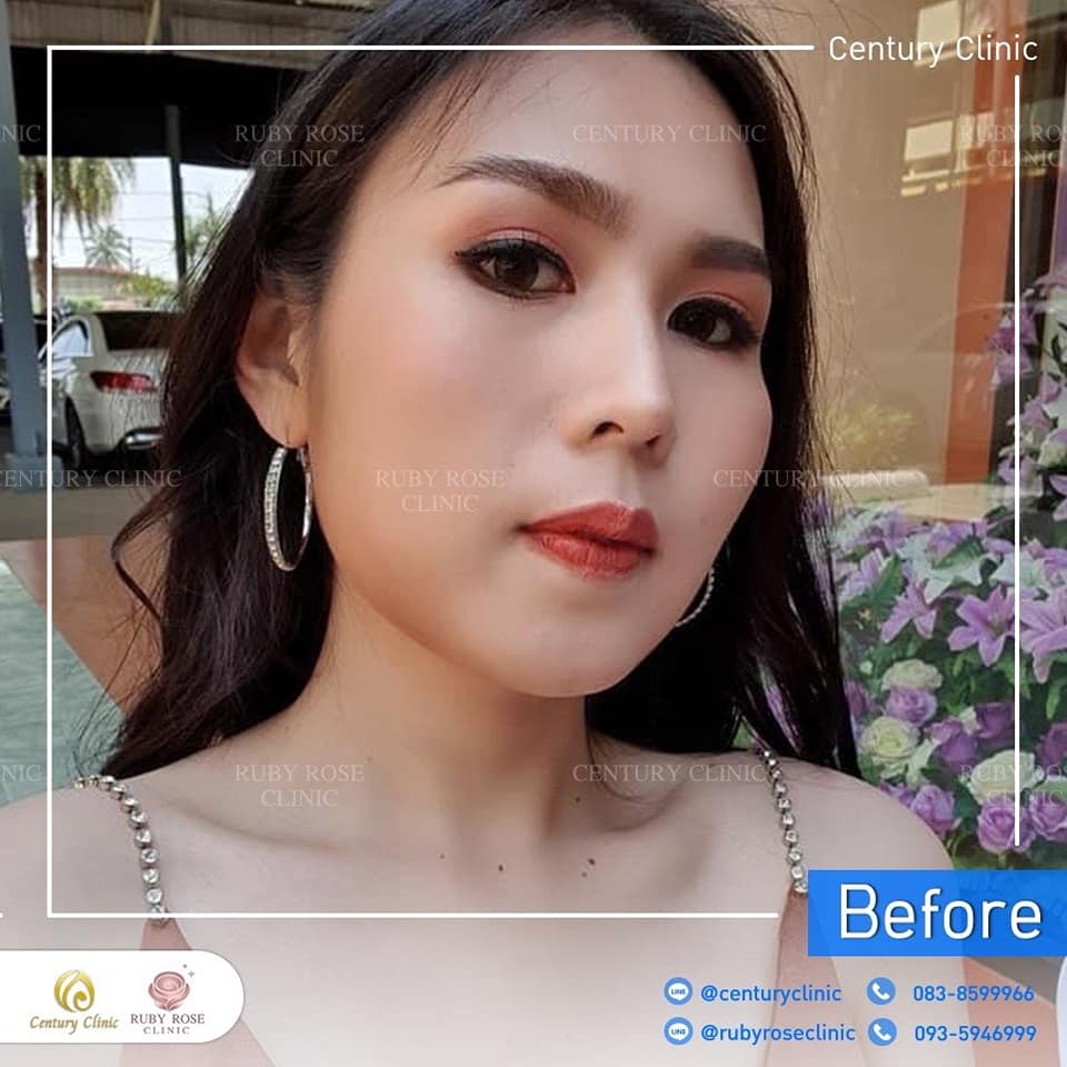 รีวิว แก้จมูก #506 , Century Clinic Thailand Century-รีวิว-แก้จมูก 1#506