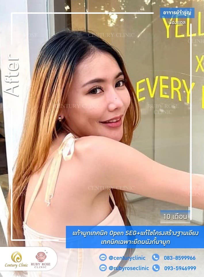 Century-รีวิว-แก้จมูก 1#508