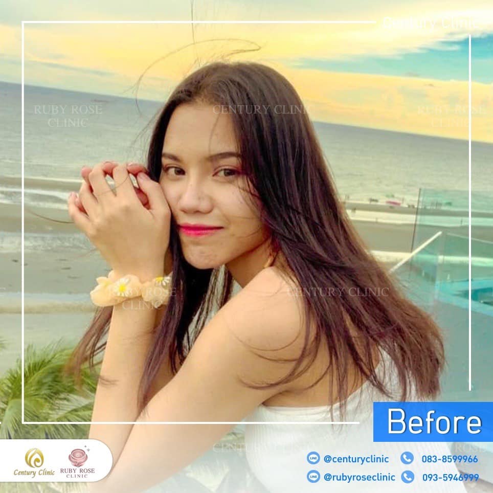 รีวิว แก้จมูก #423 , Century Clinic Thailand Century-รีวิว-แก้จมูก 2#423