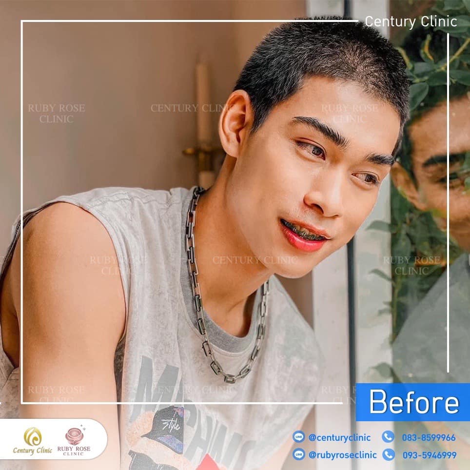 Century-รีวิว-แก้จมูก 2#424
