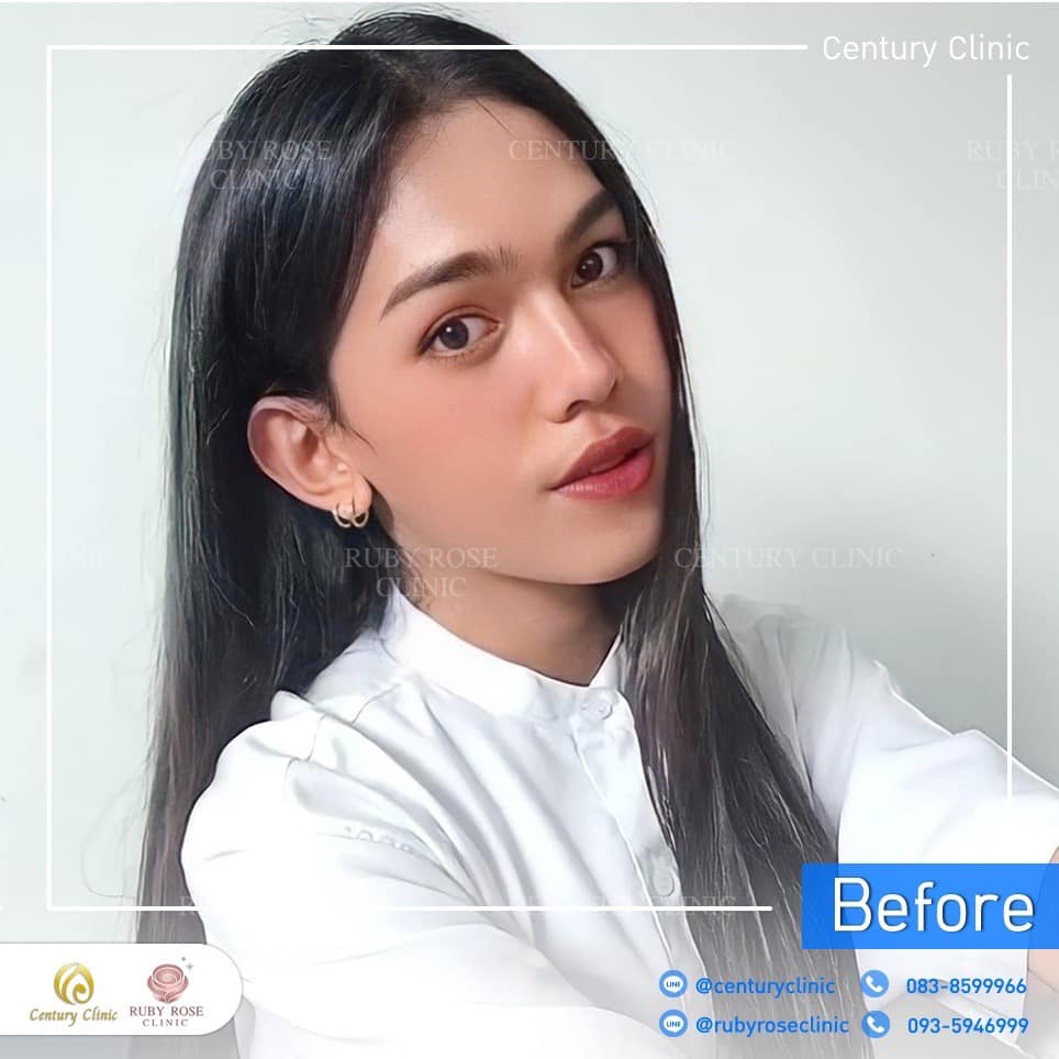 รีวิว แก้จมูก #436 , Century Clinic Thailand Century-รีวิว-แก้จมูก 2#436