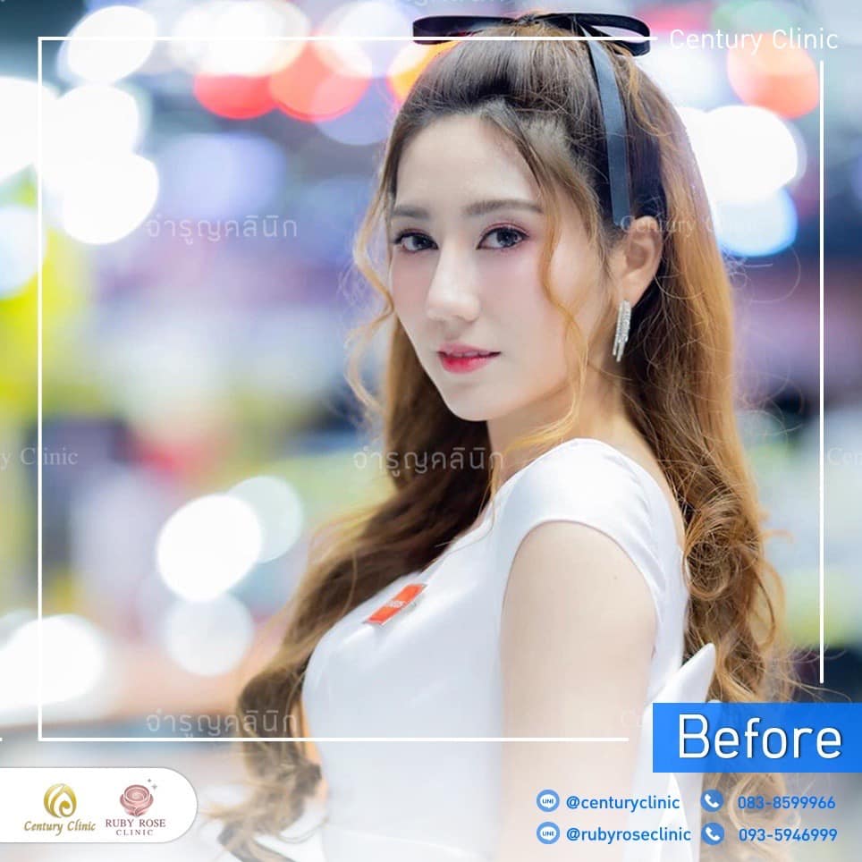 Century-รีวิว-แก้จมูก 2#444