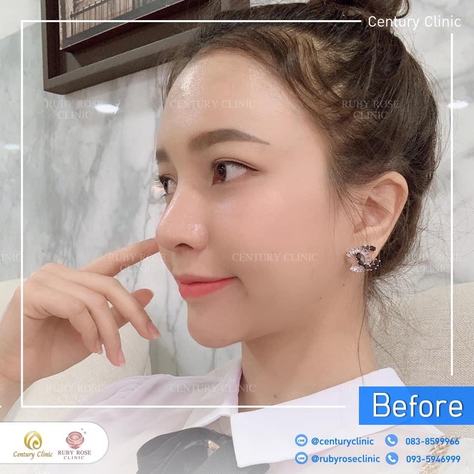 รีวิว แก้จมูก #447 , Century Clinic Thailand Century-รีวิว-แก้จมูก 2#447