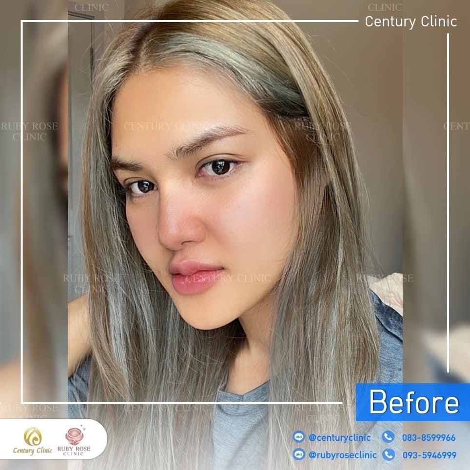 รีวิว แก้จมูก #451 , Century Clinic Thailand Century-รีวิว-แก้จมูก 2#451