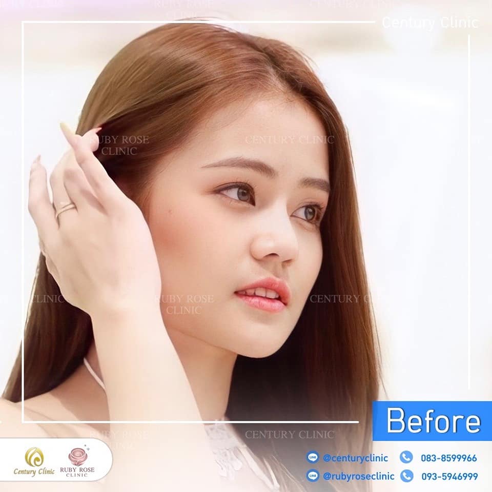 รีวิว แก้จมูก #454 , Century Clinic Thailand Century-รีวิว-แก้จมูก 2#454