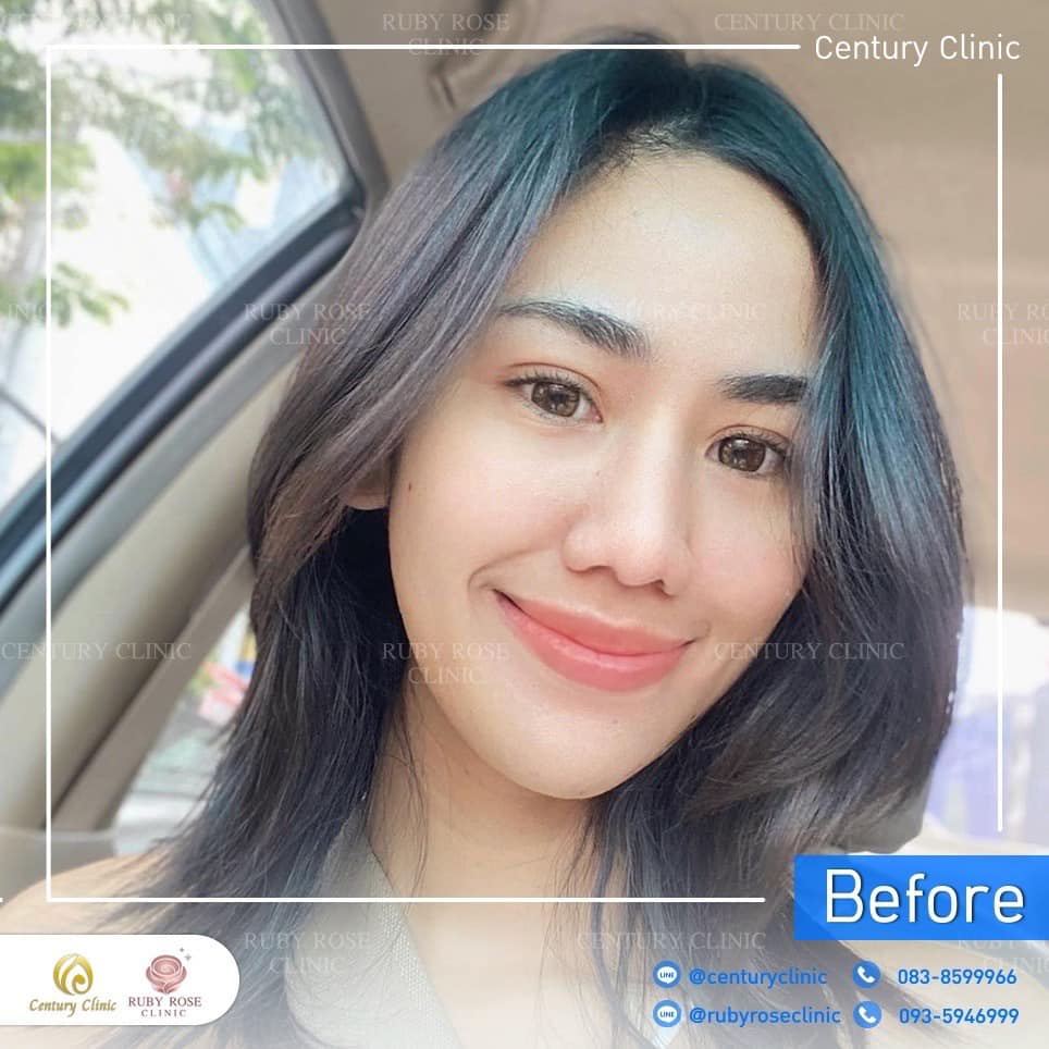 Century-รีวิว-แก้จมูก 2#463
