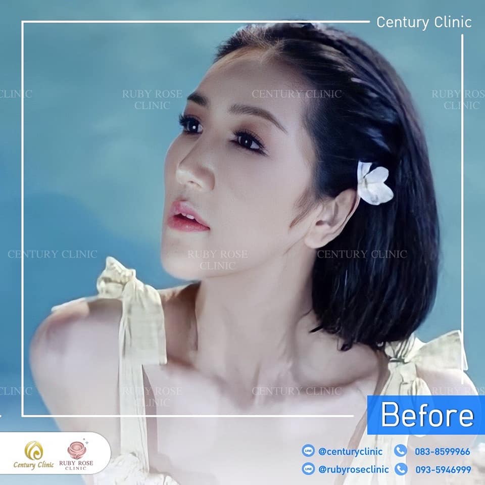 รีวิว แก้จมูก #465 , Century Clinic Thailand Century-รีวิว-แก้จมูก 2#465