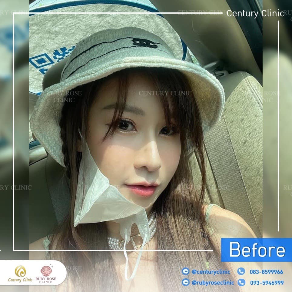 รีวิว แก้จมูก #469 , Century Clinic Thailand Century-รีวิว-แก้จมูก 2#469