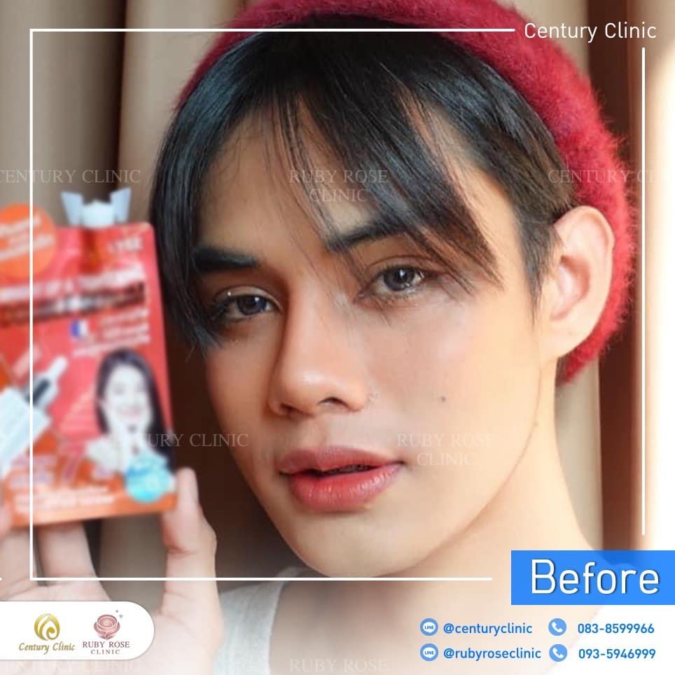 รีวิว แก้จมูก #470 , Century Clinic Thailand Century-รีวิว-แก้จมูก 2#470