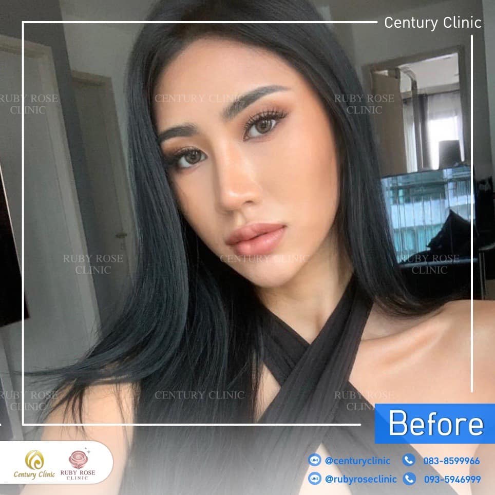 Century-รีวิว-แก้จมูก 2#474
