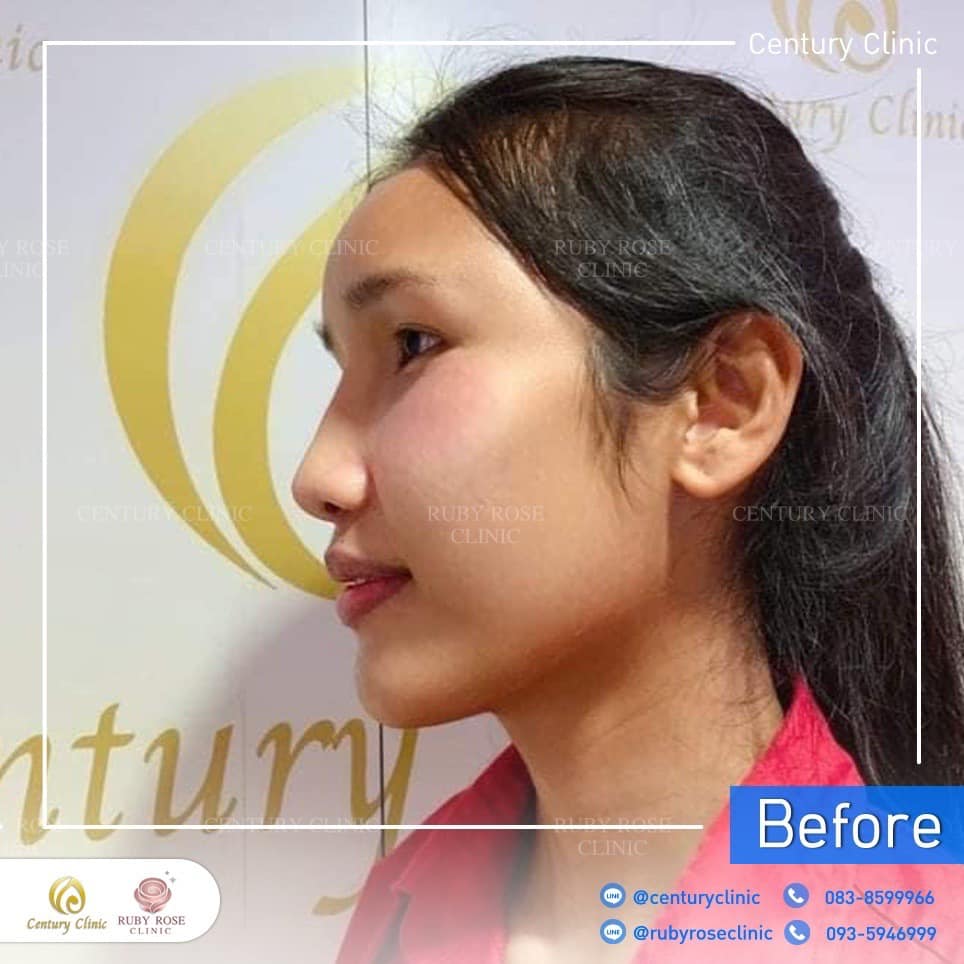 Century-รีวิว-แก้จมูก 2#478