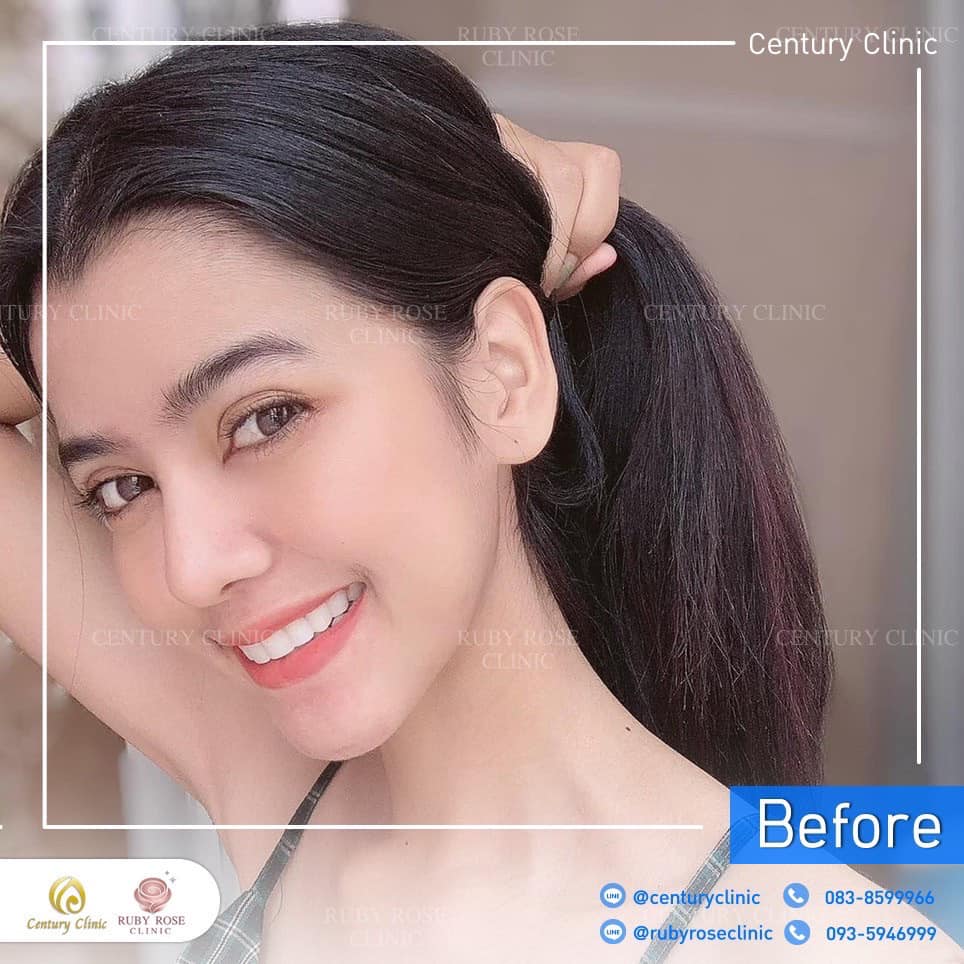 Century-รีวิว-แก้จมูก 2#483