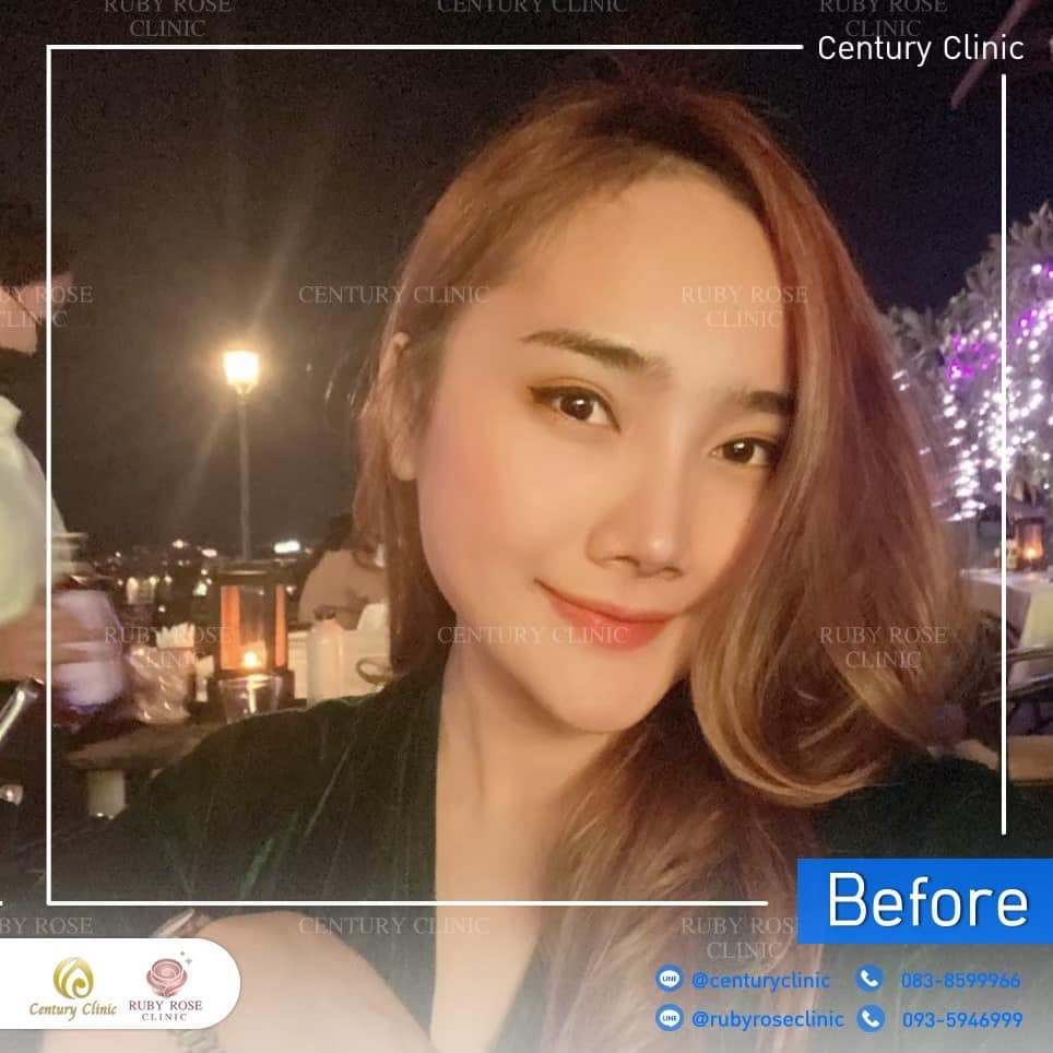 รีวิว แก้จมูก #485 , Century Clinic Thailand Century-รีวิว-แก้จมูก 2#485