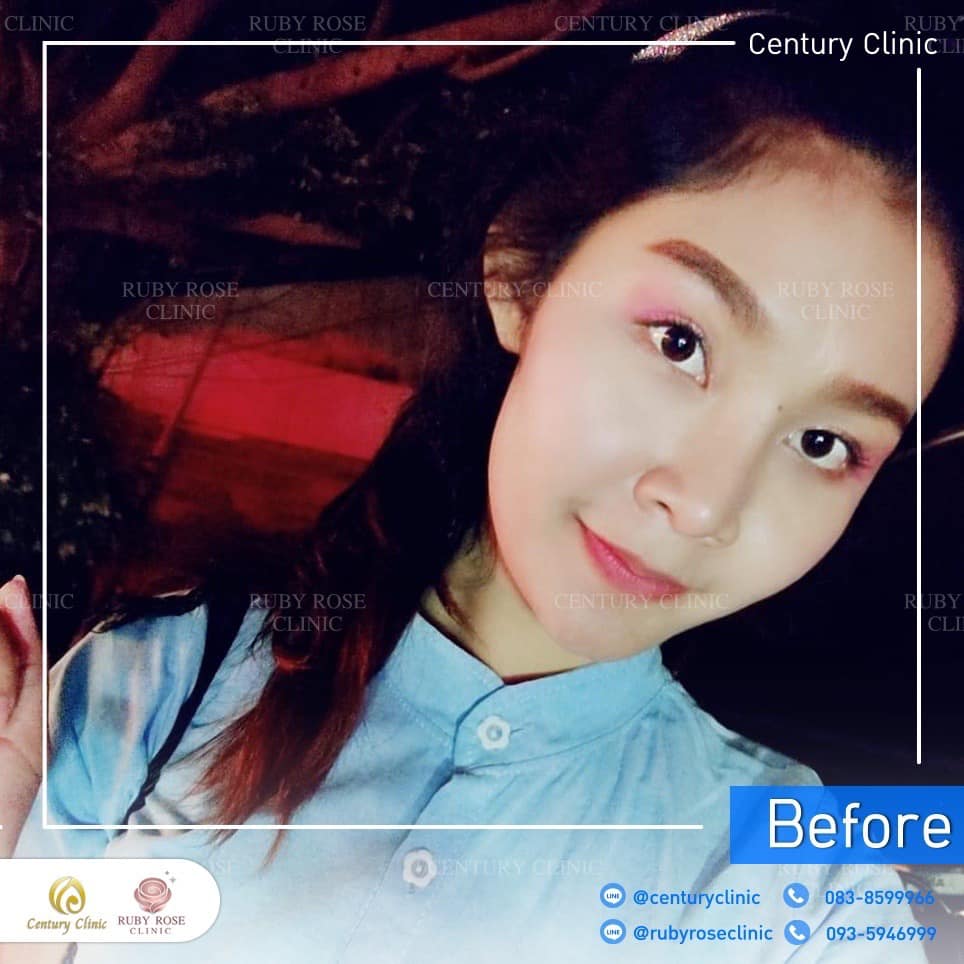 รีวิว แก้จมูก #487 , Century Clinic Thailand Century-รีวิว-แก้จมูก 2#487