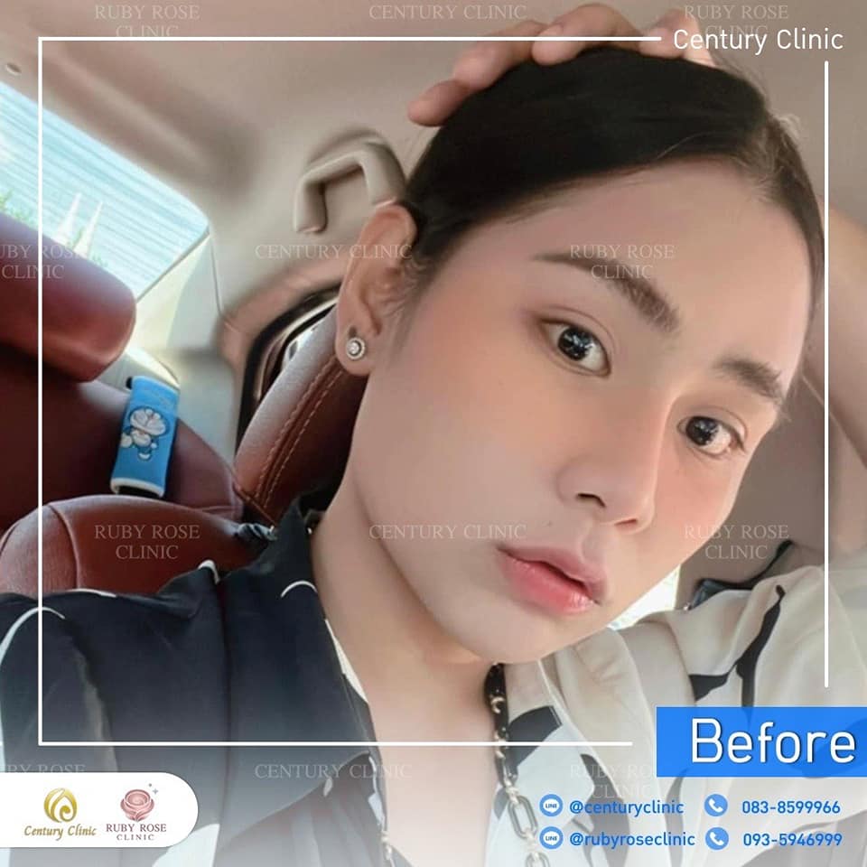 Century-รีวิว-แก้จมูก 2#490