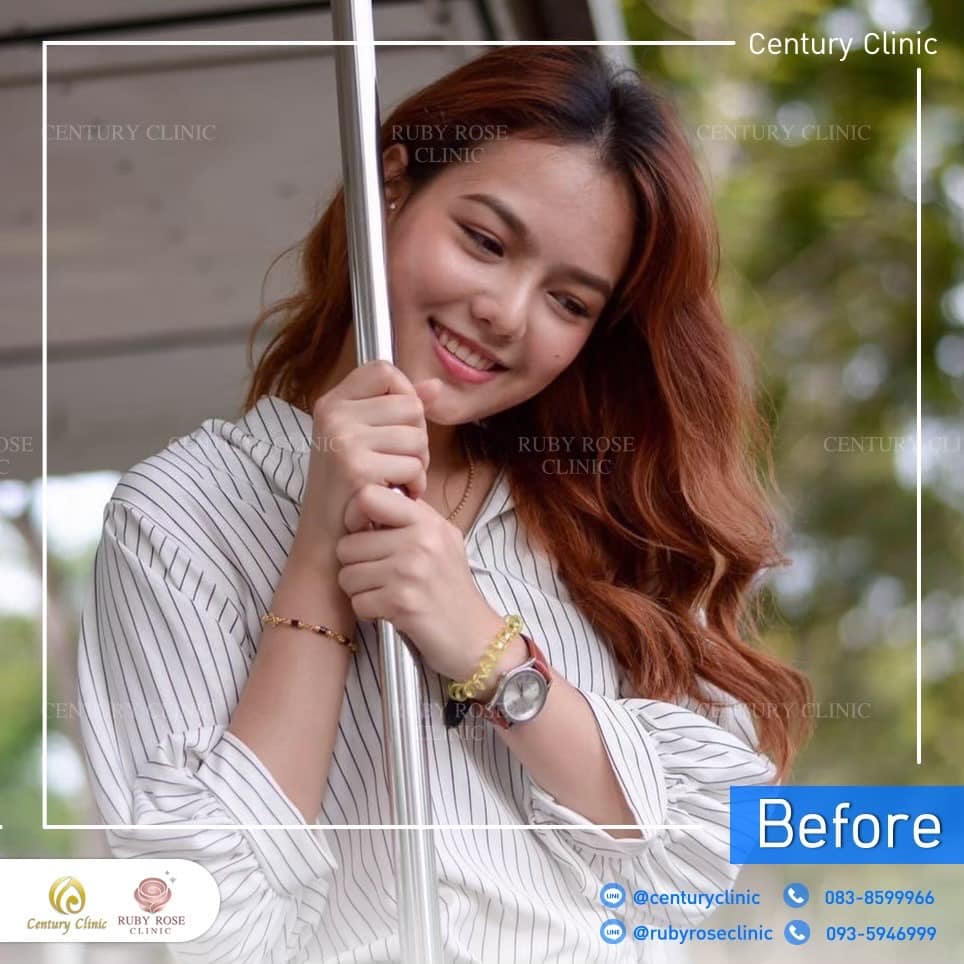 Century-รีวิว-แก้จมูก 2#491