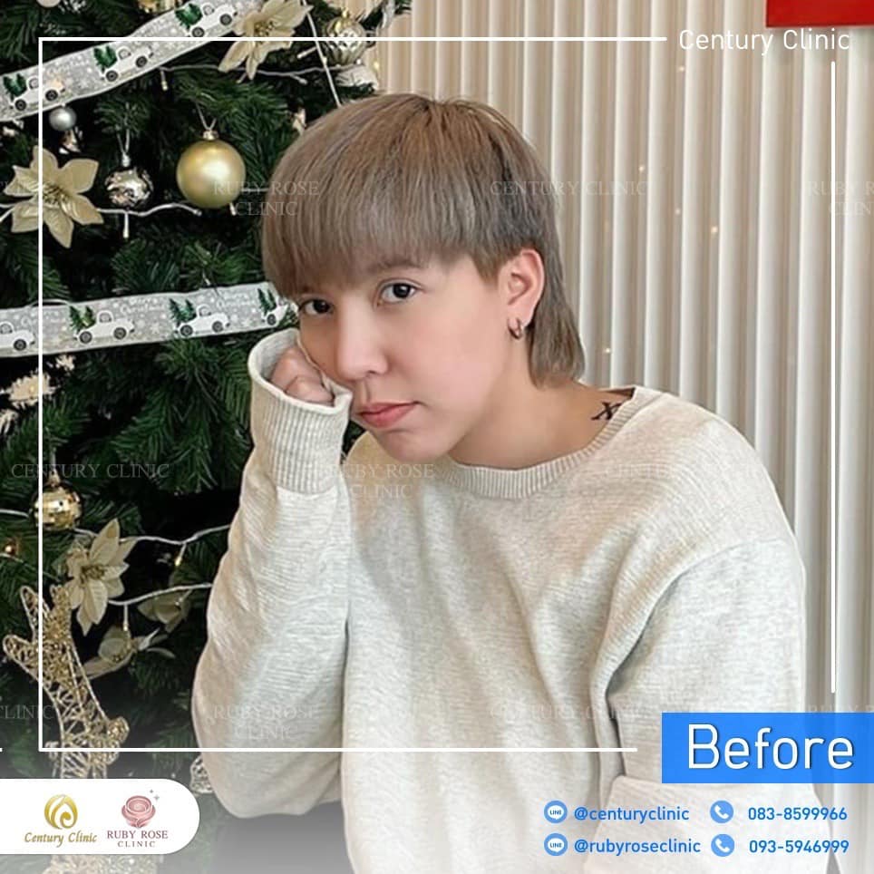 Century-รีวิว-แก้จมูก 2#494