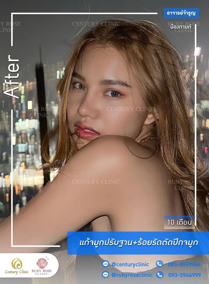 Century-รีวิว-แก้จมูก #423