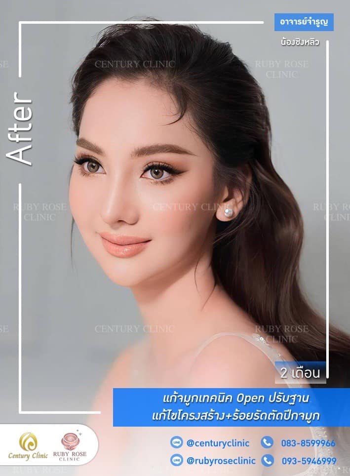 Century-รีวิว-แก้จมูก #429