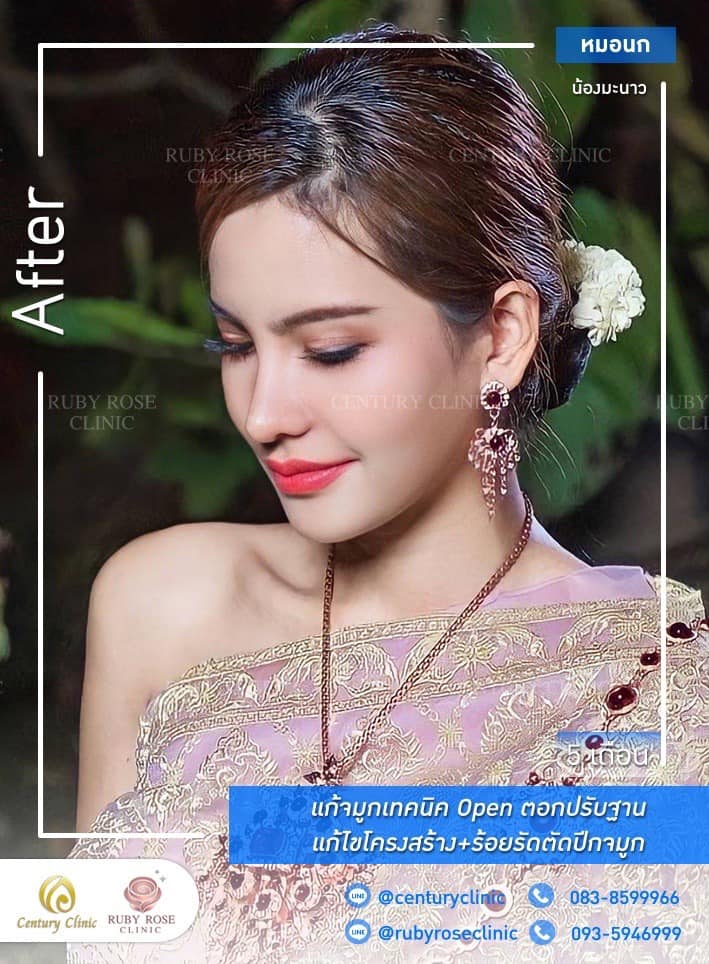 รีวิว แก้จมูก #431 , Century Clinic Thailand Century-รีวิว-แก้จมูก #431