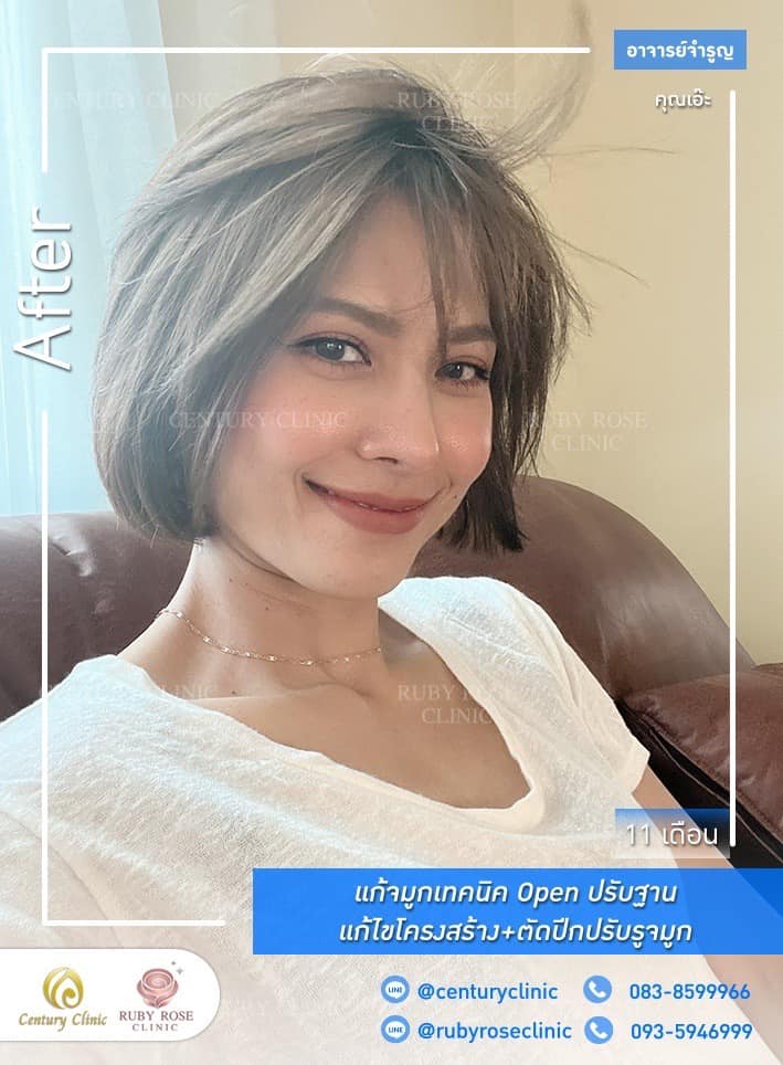 Century-รีวิว-แก้จมูก #434