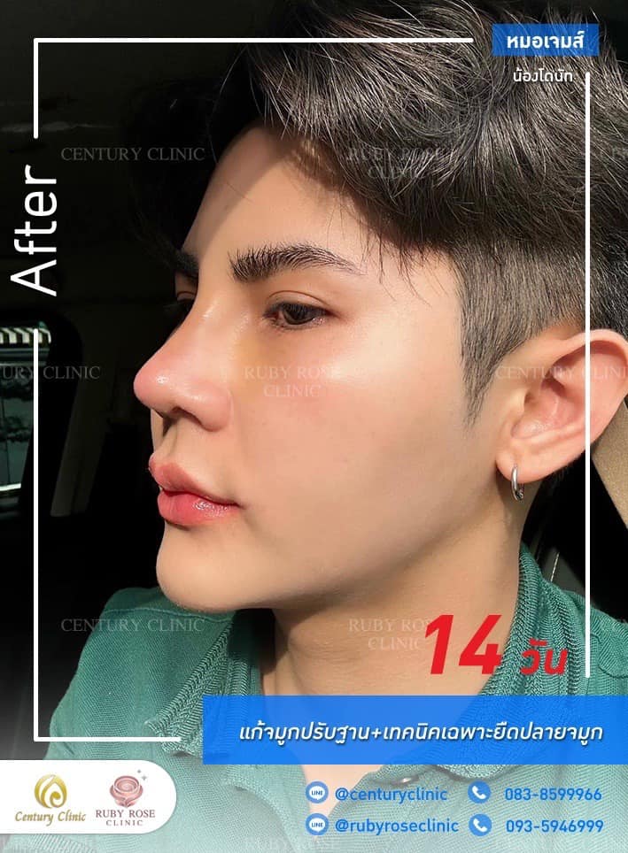 Century-รีวิว-แก้จมูก #435