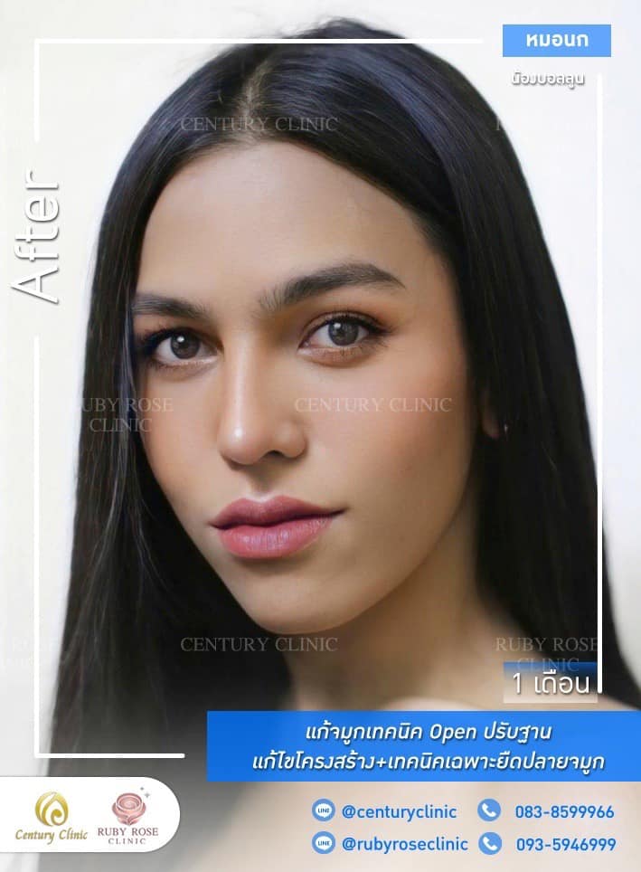 Century-รีวิว-แก้จมูก #436
